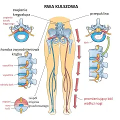 Rwa kulszowa u biegacza: jak wrócić do biegania bez ryzyka?