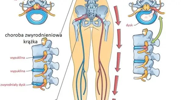 Rwa kulszowa u biegacza: jak wrócić do biegania bez ryzyka?