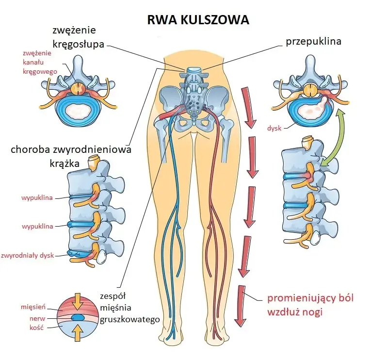 Rwa kulszowa u biegacza: jak wrócić do biegania bez ryzyka?